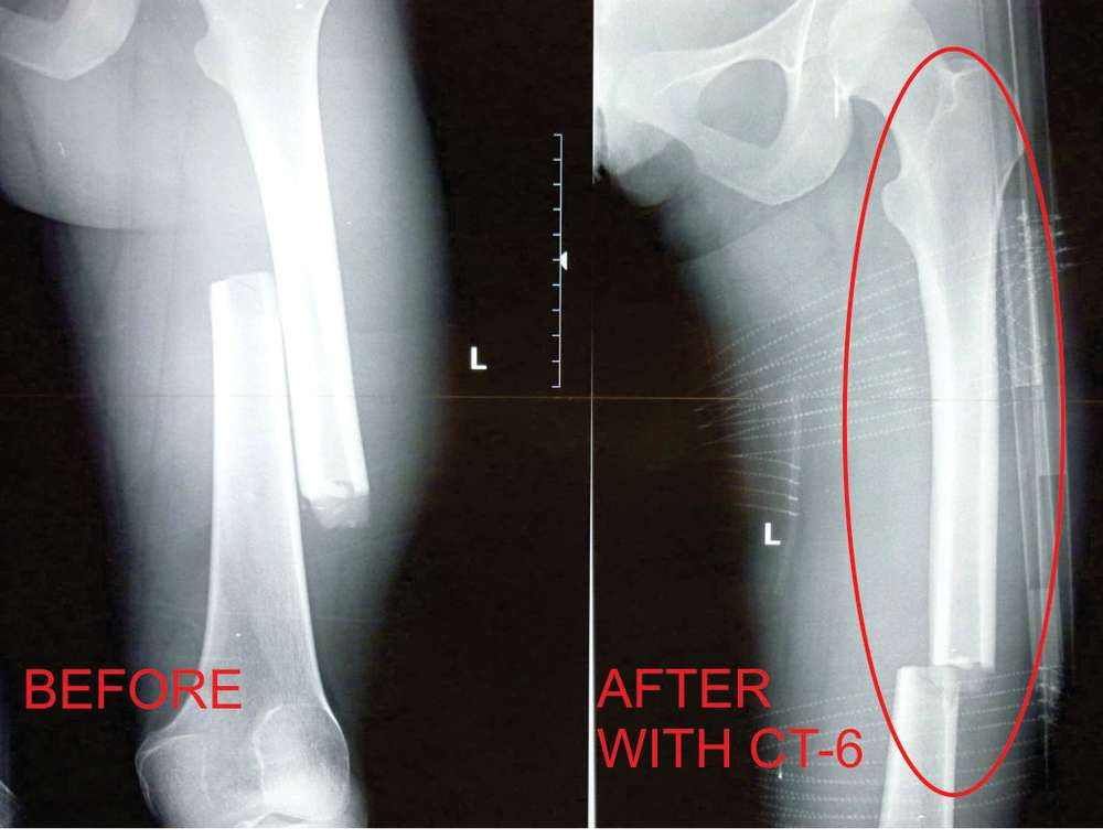 CT6_tractiesplint_Xray.591fe0.jpg